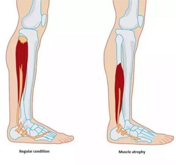 久坐导致肌肉萎缩示意图