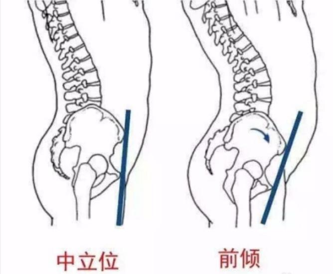 骨盆前倾示意图