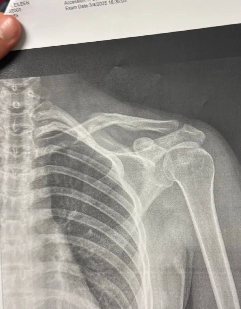 谷爱凌受伤骨折图